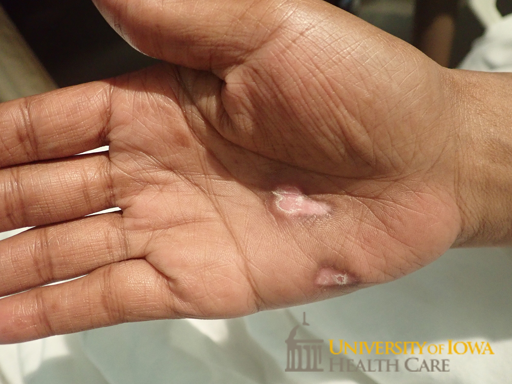 Well demaracated, shiny, and atrophic plaque with central depigmentation and rim of hyperpigmentation and central scale on the palm. (click images for higher resolution).